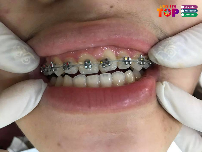 nha-khoa-toan-y-bentretoplist