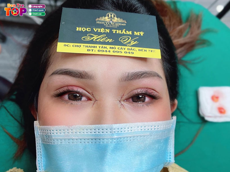 Tham-my-hien-vy-ben-tre-bentretoplist