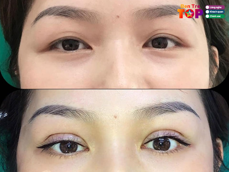 Tham-my-hien-vy-bentretoplist