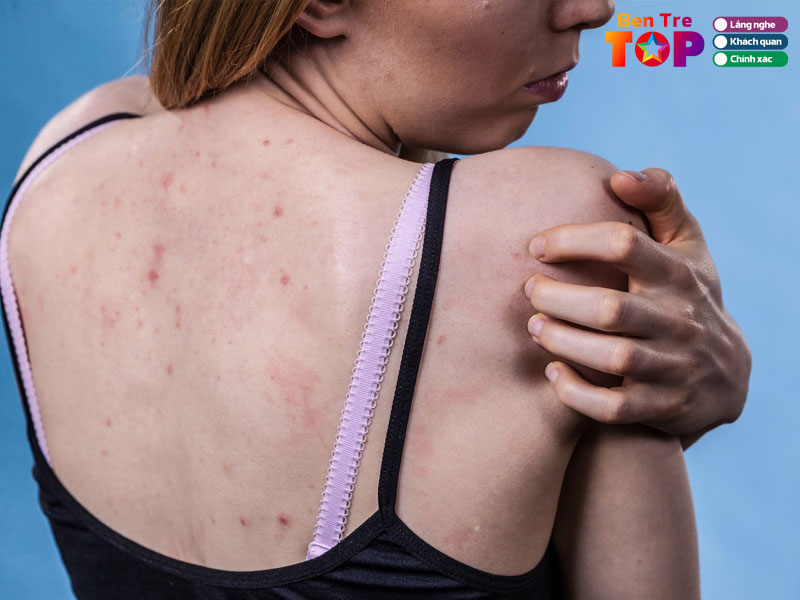 Nhung-luu-y-khi-lua-chon-spa-dieu-tri-mun-lung-bentretoplist