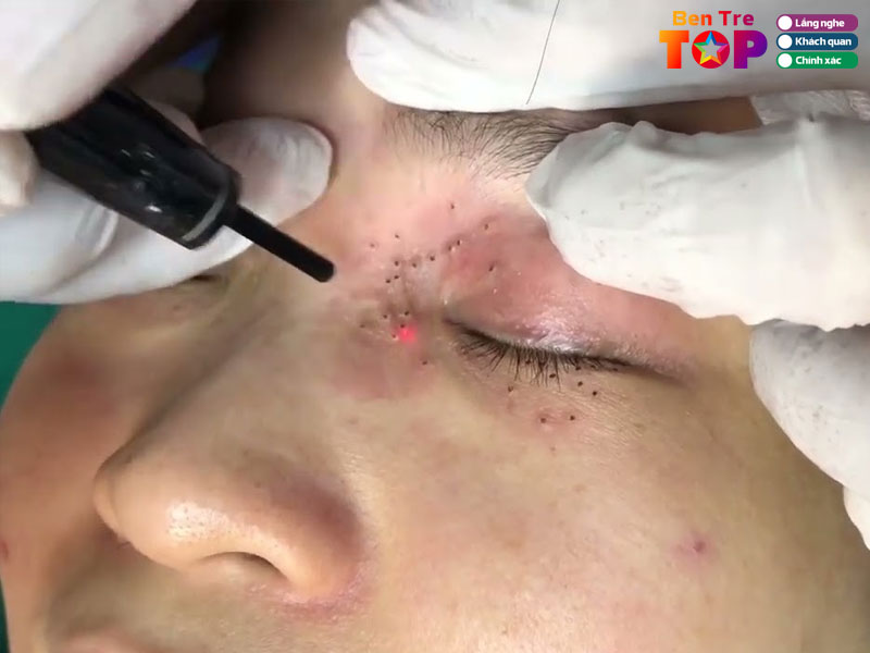 Cham-soc-da-sau-khi-dot-mun-thit-nhu-the-nao-bentretoplist