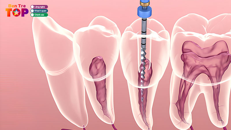 Top-10-nha-khoa-dieu-tri-tuy-rang-o-ben-tre-an-toan-chi-phi-hop-ly-bentretoplist