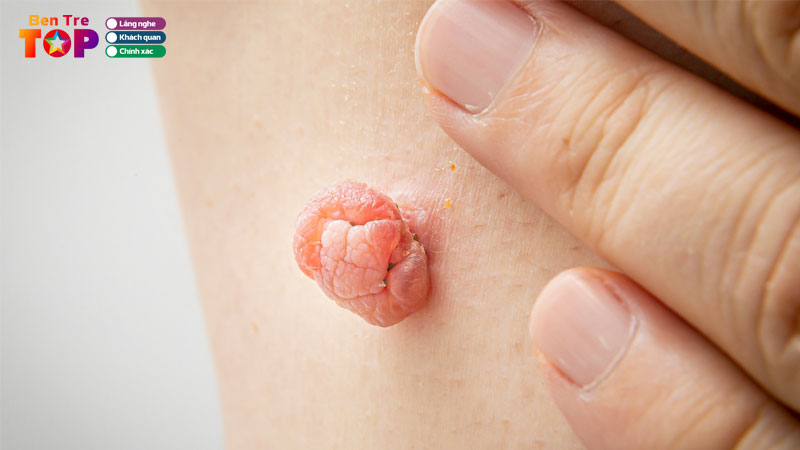 Top-10-spa-dot-mun-thit-o-ben-tre-lam-sach-nhanh-khong-dau-bentretoplist